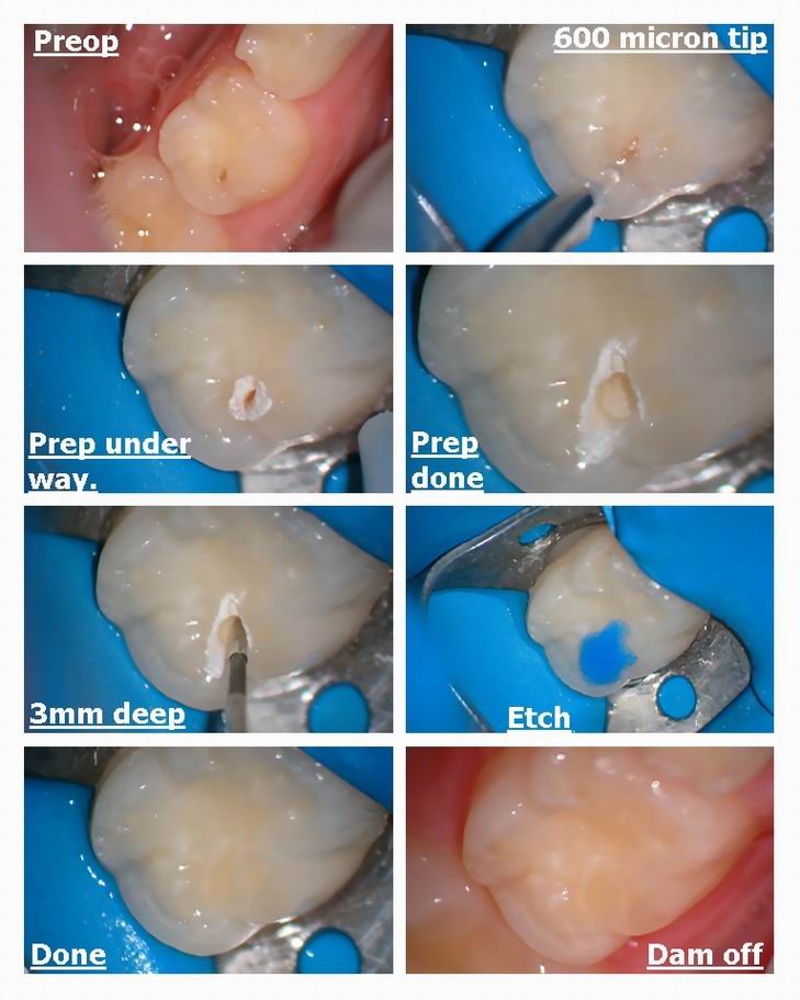 Resize of Small one on primary molar.jpg